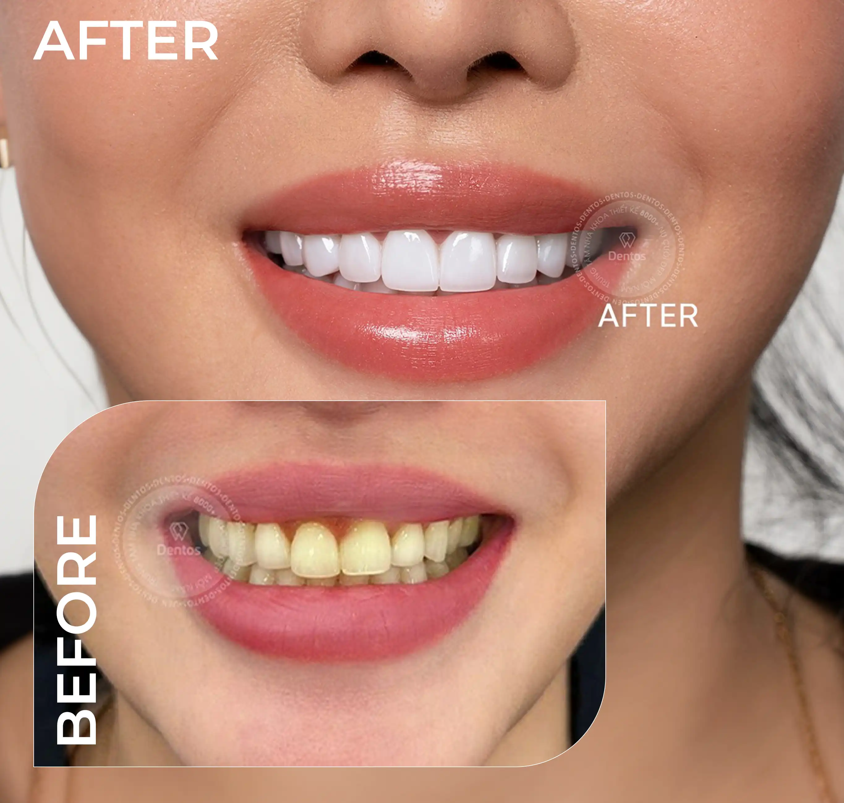 Trường hợp răng ố vàng nhẹ chỉ nên dán Veneer